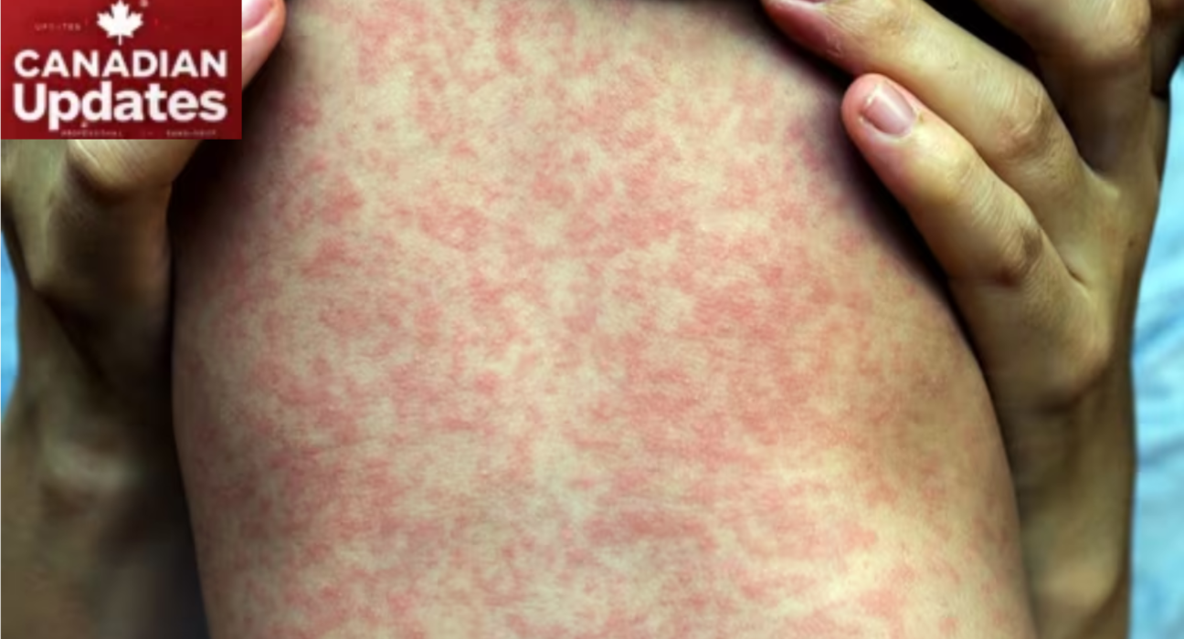 Measles Outbreak in Wonowon, British Columbia