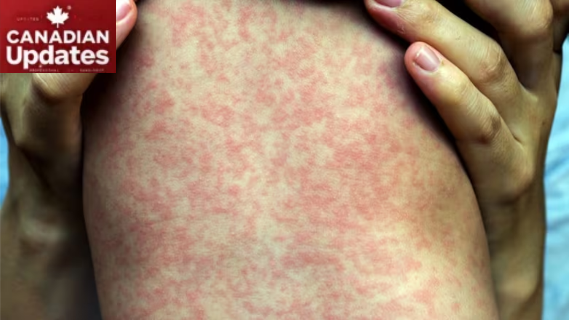 Measles Outbreak in Wonowon, British Columbia